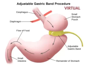 Adjustable Gastric Band Procedure